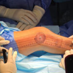 Niño de 11 años protagoniza primera cirugía reconstructiva ortopédica en Monagas